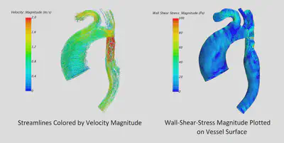 Results of CFD modeling of the hemodynamic situation in a patient with aortic isthmic stenosis.