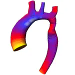 3D Shape Analysis for Coarctation of the Aorta